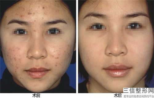 云浮博研医疗美容诊所疤痕加压治疗手术费用要多少